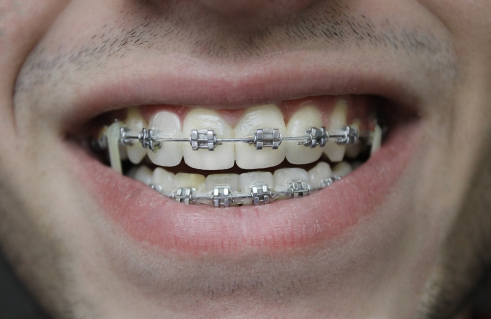 Does My Child Need Braces?