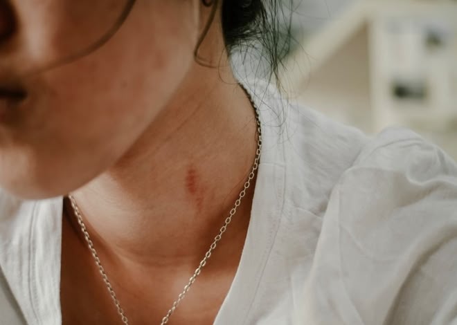 How to Get Rid of Acne Scars