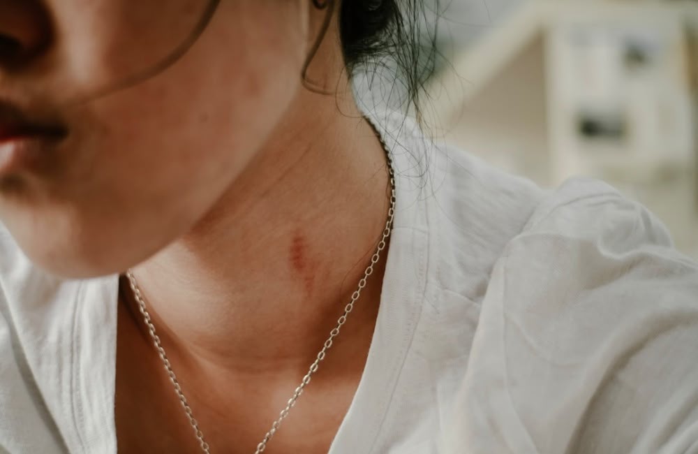 How to Get Rid of Acne Scars