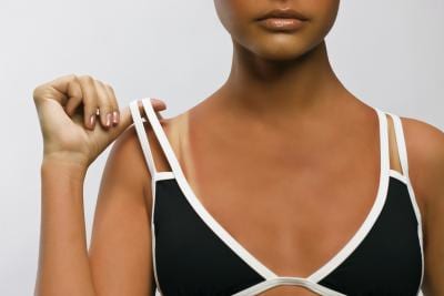 How to Stop Sunburns from Itching