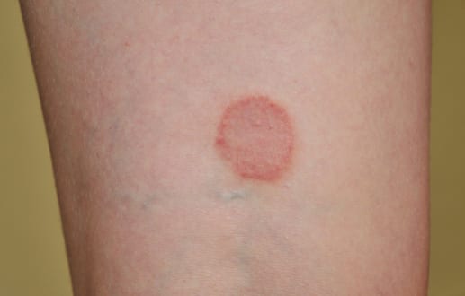 How to Diagnose Ringworm