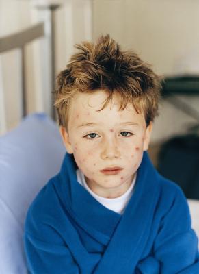 Measles, Mumps and Chicken Pox