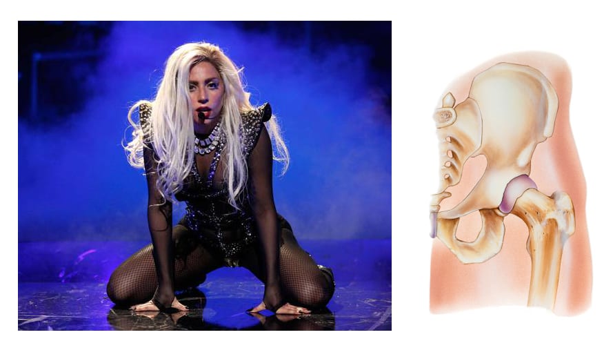 Lady Gaga’s Hip Labral Tear: Are You at Risk for One?