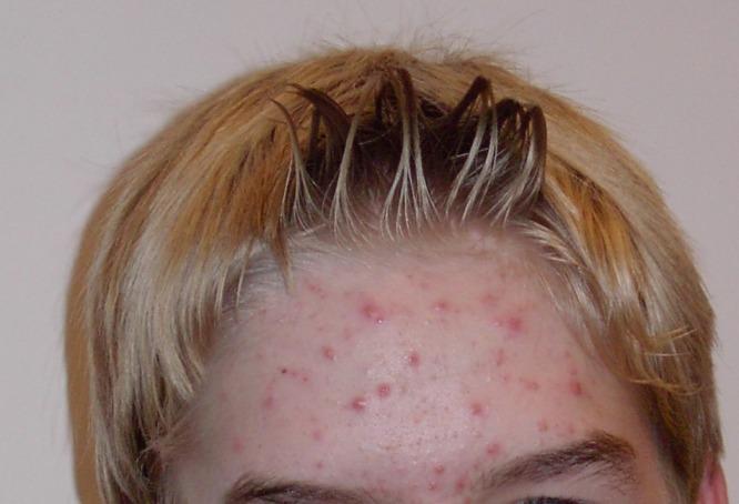 Herbal Remedies for Acne