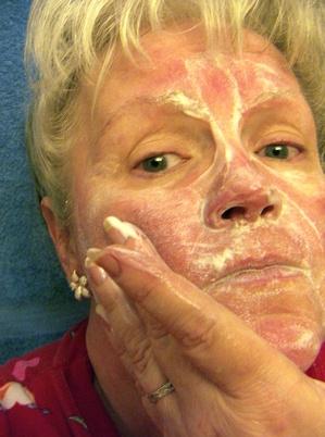 About Skin Care Products for Rosacea
