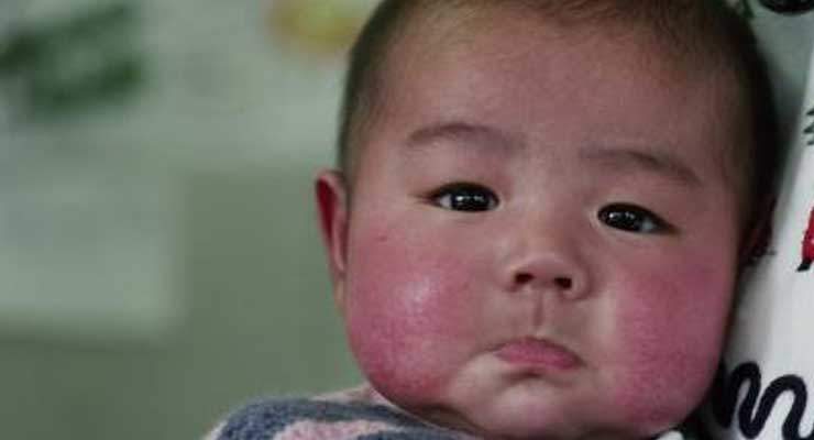 Toddler Rosacea