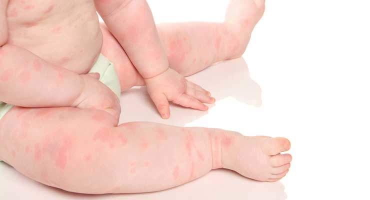 When to Call the Doctor for a Rash on a Baby