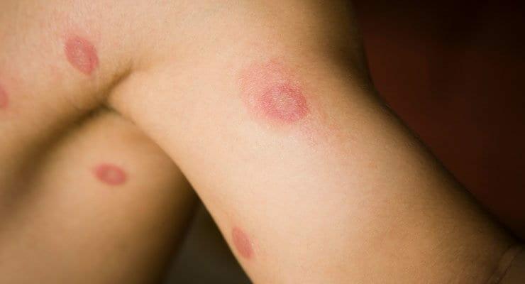 Kids & Ringworm
