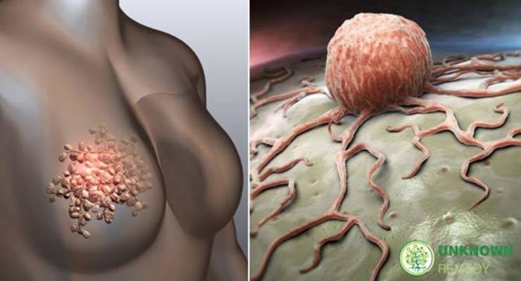 Women Need To Pay Attention to these 5 Signs of Breast Cancer